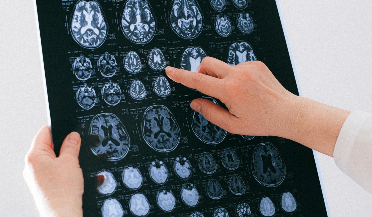 Forscher identifizieren wiederkehrende Immunmuster im kranken Gehirn